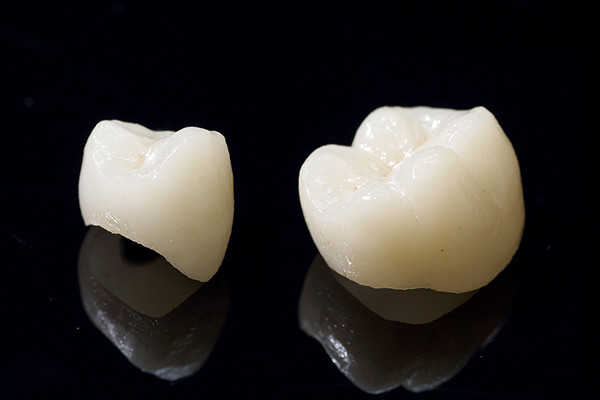 むし歯が大きい場合の歯の被せ物（クラウン）の紹介